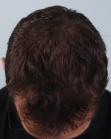 After Hair Transplant&nbsp;Hairlines